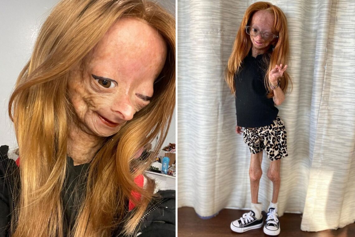 How Adalia Rose touched the hearts of millions including J.Lo’s dress designer as real life Benjamin Button girl dies How Adalia Rose touched the hearts of millions including J.Lo’s dress designer as real life Benjamin Button girl dies