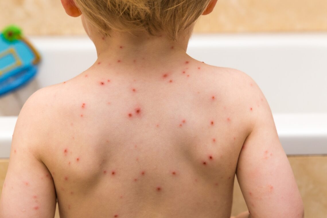 I’m a GP and here’s the mistake so many parents make when it comes to chickenpox