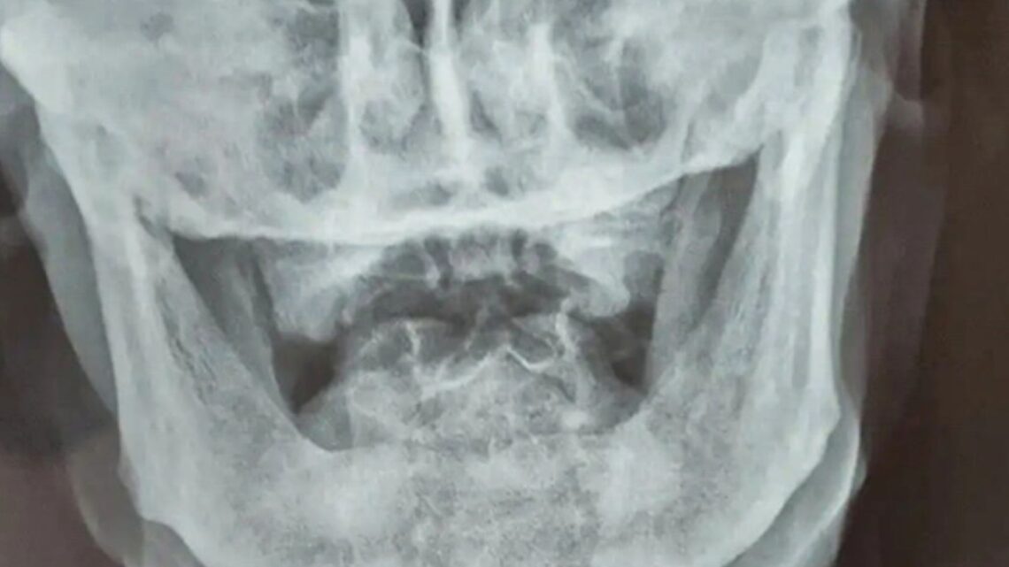 War vet stunned as X-ray shows shock neck injury that had been there for nearly EIGHTY YEARS… and he didn’t even realise
