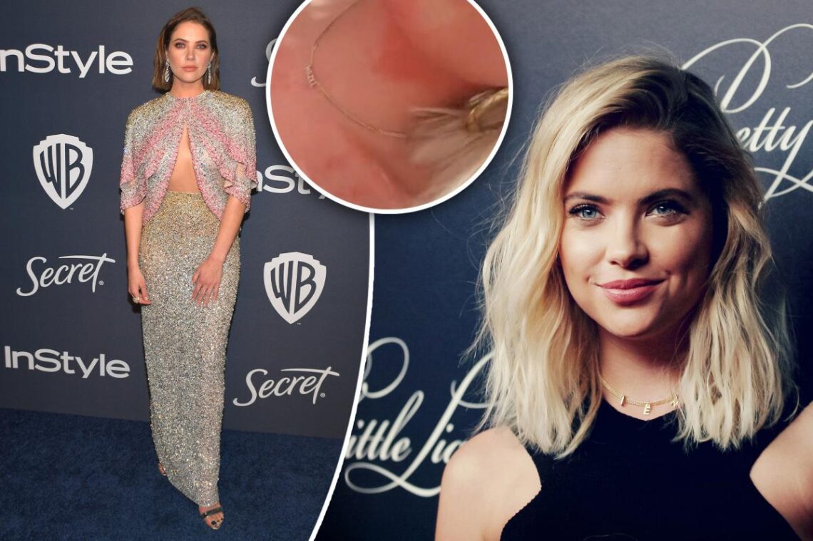 Ashley Benson shows anxiety-induced rash that takes over her ‘whole body’